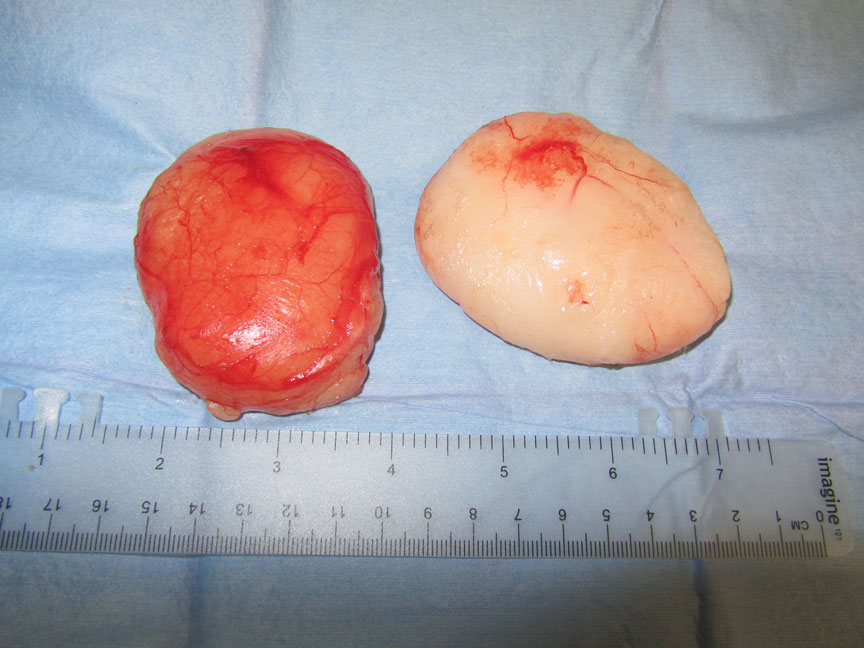 Two lipomas surgically removed from the inguinal area or groin because of recent rapid growth